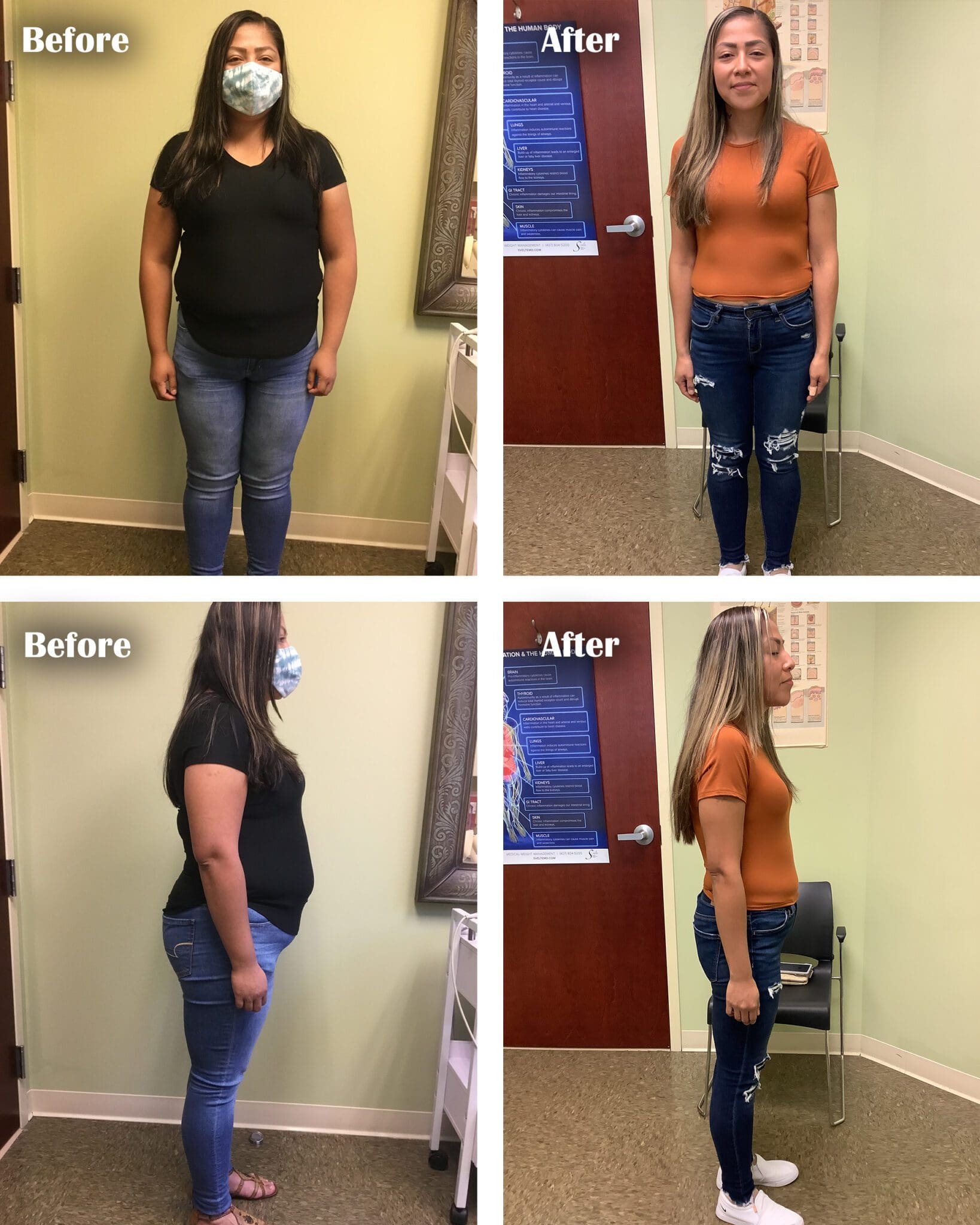 Semaglutide Weight Loss Orlando 407 804 5200