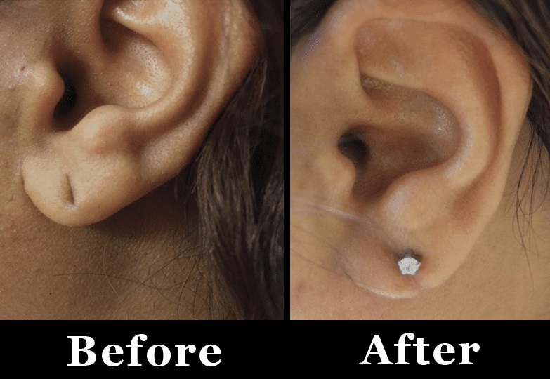 ear lobe repair before and after